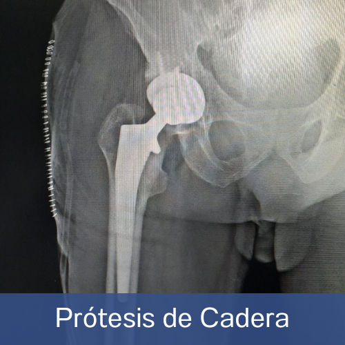 Dr. Eduardo Villanueva Manzo Prótesis de cadera